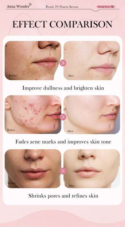 Anua Peach 70% Niacinamide Serum for Bright &amp; Glowing Skin