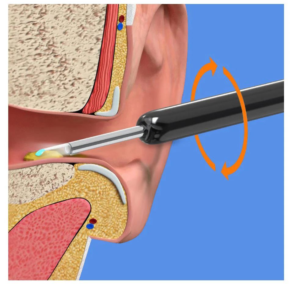 Illustration of a medical tool being inserted into an ear canal with cross-sectional views of the ear.